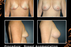 BreastAug-0796
