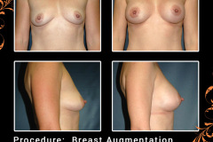 BreastAug-0818