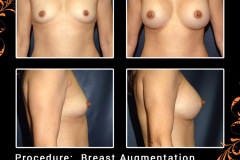 BreastAug-0986