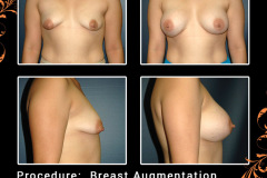 BreastAug-1033