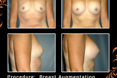 BreastAug-1189