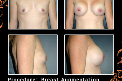 BreastAug-1693
