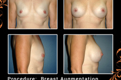 BreastAug-1847