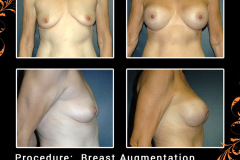 BreastAug-1944