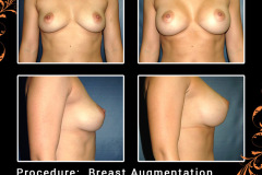 BreastAug-1969
