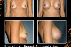 BreastAug-2018