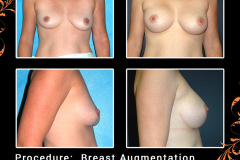 BreastAug-2125