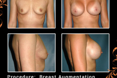BreastAug-2215