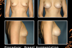 BreastAug-2239