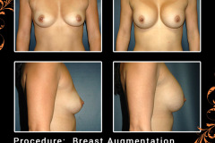 BreastAug-2352