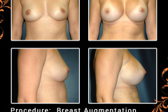 BreastAug-2363