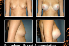 BreastAug-2483