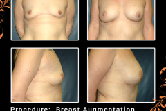 BreastAug-2617