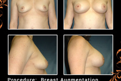 BreastAug-2632
