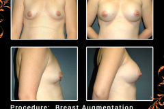 BreastAug-2642