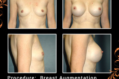 BreastAug-2652