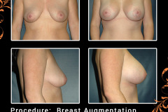 BreastAug-2658