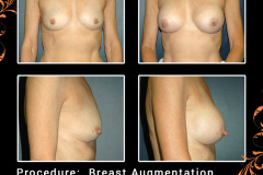 BreastAug-2793