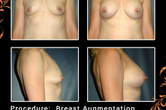 BreastAug-2803