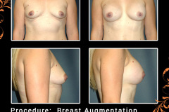 BreastAug-2829