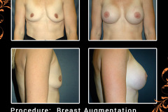 BreastAug-2898