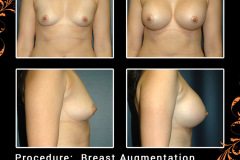 BreastAug-2933