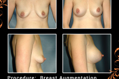 BreastAug-2965
