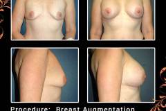 BreastAug-3073a