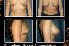 BreastAug-3089