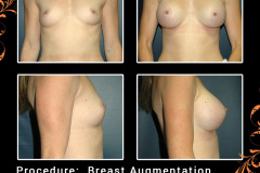 BreastAug-3116
