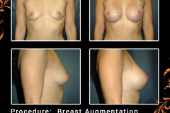 BreastAug-3125