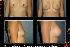 BreastAug-3137