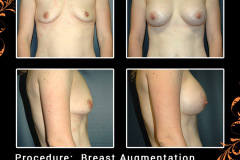 BreastAug-3484