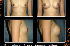 BreastAug-3581
