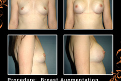 BreastAug-3622