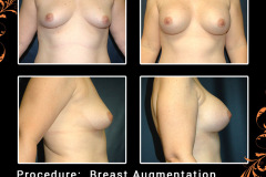 BreastAug-3744
