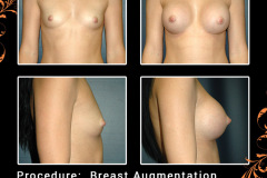BreastAug-3794