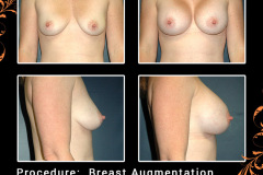 BreastAug-3802