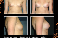 BreastAug-3837