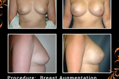 BreastAug-4025