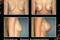 BreastAug-4059