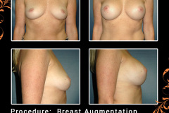 BreastAug-4143