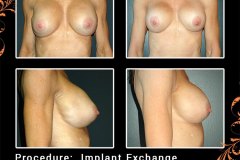 BreastAug-4169
