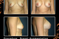 BreastAug-4242