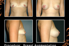BreastAug-4328