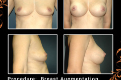BreastAug-5060