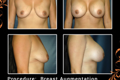 BreastAug-5323