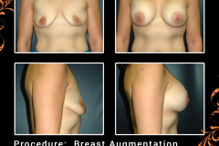 BreastAug-5353