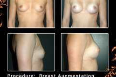 BreastAug-5696