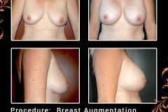 BreastAug-5723